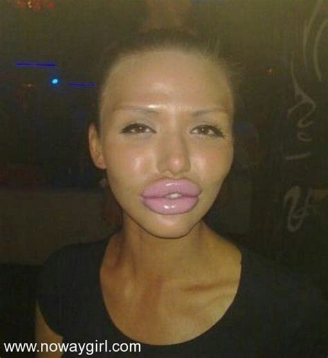 Mess Up Plastic Surgery Gone Wrong Botox Lips Fake Lips