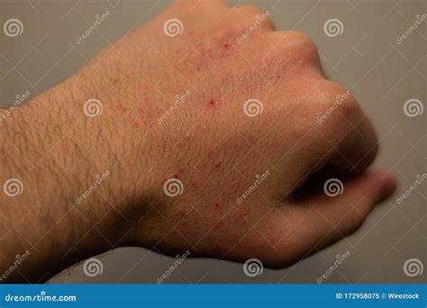 Closeup Of The Hand Of A Person Covered In Small Itchy Bumps Under The