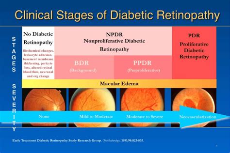 Stages Of Progression Of Diabetic Retinopathy Image Courtesy Of Lloyd