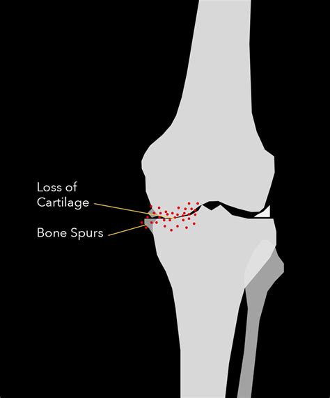 Lack Of Cartilage In Knee Human Anatomy