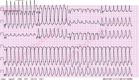 Monomorphic Sustained Ventricular Tachycardia ECG Example Learn The Heart