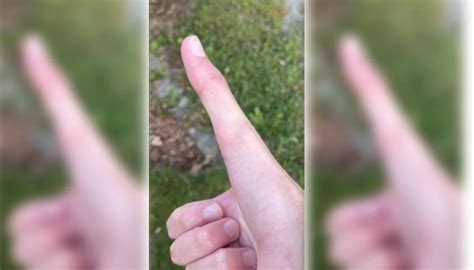 Us Man Goes Viral On Tiktok For Biggest Thumb In The World Newshub