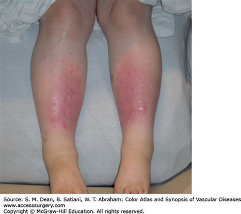 Stasis Dermatitis Color Atlas And Synopsis Of Vascular Diseases