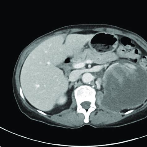 Ct Of The Abdomen And Pelvis With Iv Contrast A Transverse And B