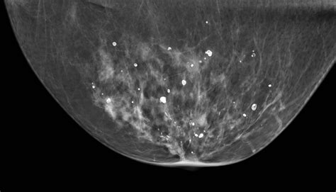 Mammographic Microcalcifications And Risk Of Breast Cancer Research