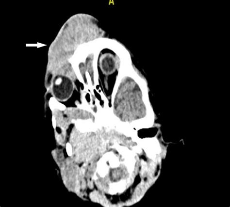 Cureus Extensive Forehead Swelling Including The Periorbital Area In