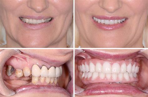 Immediate Implants And Teeth All On 4 Surgical Case Dental Implants