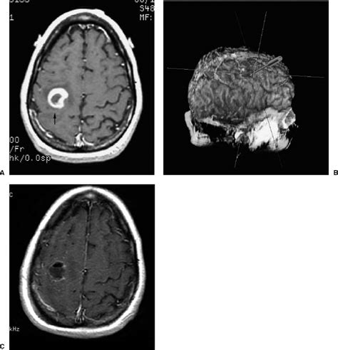 Image Guided Brain Tumor Resection Radiology Key