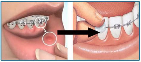 How do i stop my braces from rubbing? How to Use Orthodontic Wax | News | Dentagama