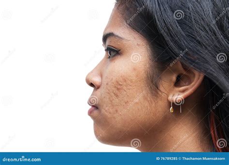 Acne On Skin Face Women Stock Image Image Of Hygiene 76789285