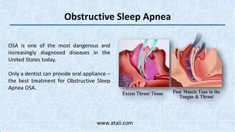 Ppt The Best Obstructive Sleep Apnea Course To Grow Your Business