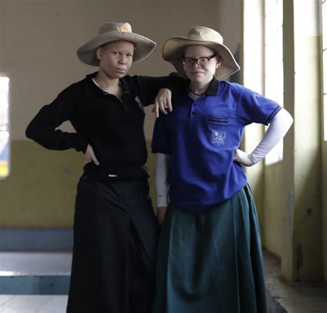 Under The Same Sun Helping People With Albinism
