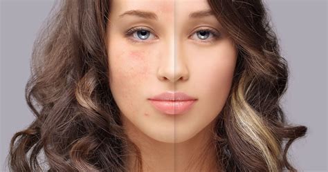 Rosacea Awareness What Is Rosacea And How Can You Combat It