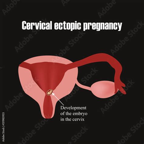 Development Of The Embryo In The Cervix Ectopic Pregnancy