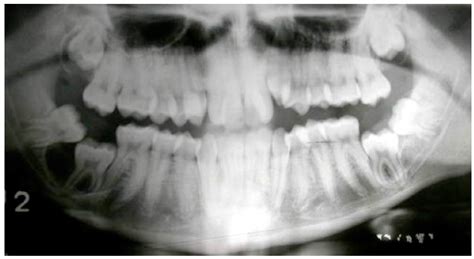 Scielo Brasil Bilateral Mandibular Dentigerous Cysts A Case Report