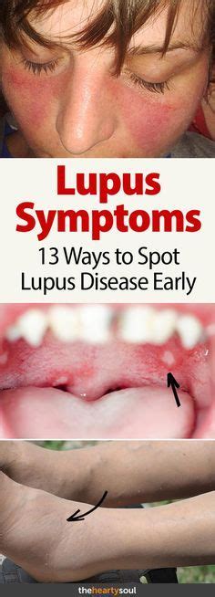Early Lupus Symptoms What You Need To Look For Lupus Symptoms