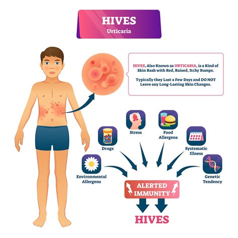 Hives Urticaria Medical Vector Illustration Infographic Diagram