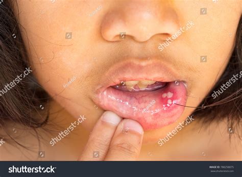 Mouth Ulcer Canker Sore Aphthous Stomatitis Stock Photo Shutterstock