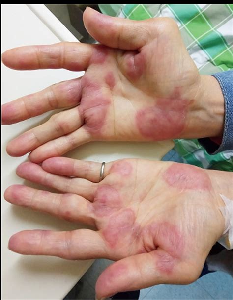 sweet s syndrome also called acute febrile neutrophilic dermatosis is a rare disease