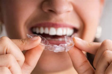 What Is Invisalign And How Does It Work Tw Orthodontics Al