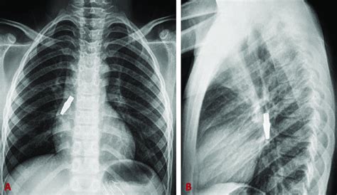 Posteroanterior A And Lateral B Chest X Ray Showed The Foreign Body