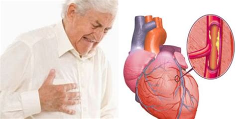 5 Gejala Penyakit Jantung Pada Pria Dan Wanita Yang Harus Diwaspadai