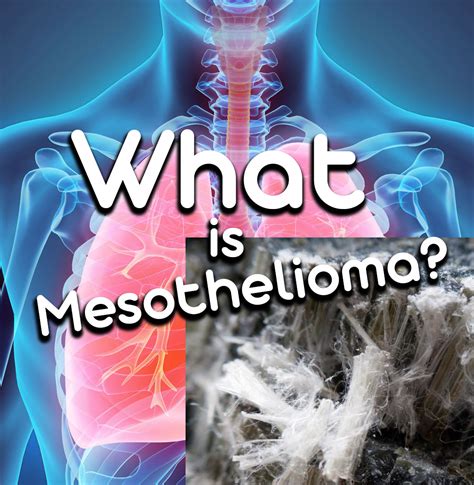 Mesothelioma Young Adults Mesothelioma Lymph Vessels Mesothelioma
