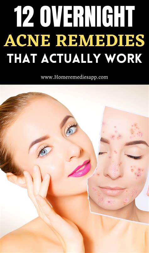 How To Get Rid Of Acne Overnight 12 Remedies That Work Acne Home