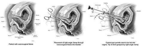 Laparoscopic Vesicovaginal Fistula Repair Vvf