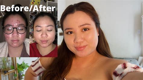 How I Cleared My Cystic Acne No Accutane Clear Acne Naturally What