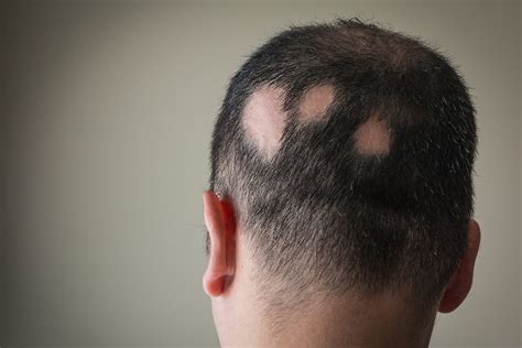LEARN THE FACTS ABOUT ALOPECIA AREATA
