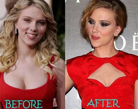 Boob Reduction Pictures