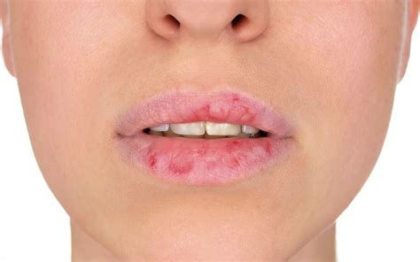 Eczema On Lips 8 Trusted Treatments Clear Skin Regime