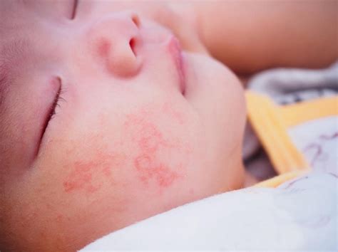 This overreaction is called an allergic reaction. Health : Allergic reaction in children and babies - what ...