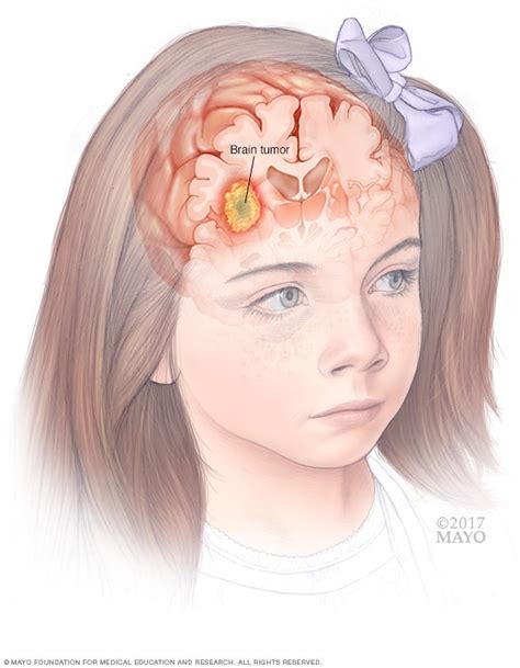 Pediatric Brain Tumors Symptoms And Causes Mayo Clinic