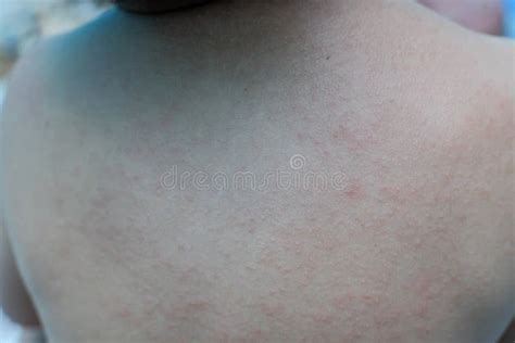 Rash On Sensitive Skin Or Skin Problem With Allergy Rash Stock Image