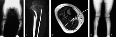 A Proximal Tibia Varus Deformity In A 22 Month Old Boy B And C