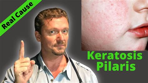 Keratosis Pilaris Fix Sign Of Serious Condition Chicken Skin Cure