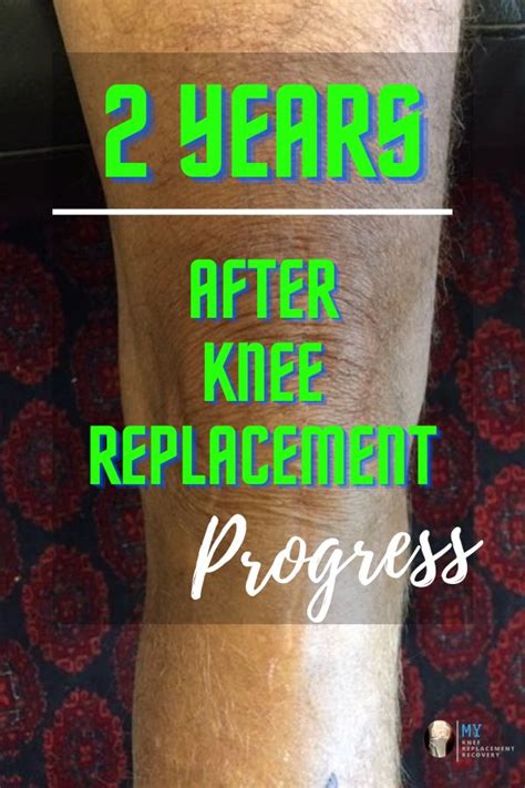 2 Years After Knee Replacement Surgery Knee Replacement Exercises