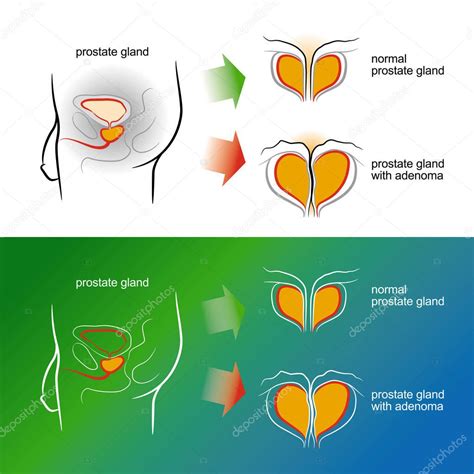 Esbozo De Una Glándula Prostática Masculina Con Adenoma Ilustración Del Vector 2022
