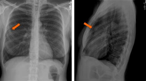 Detecting And Diagnosing Chest Trauma Through X Ray Radiographic