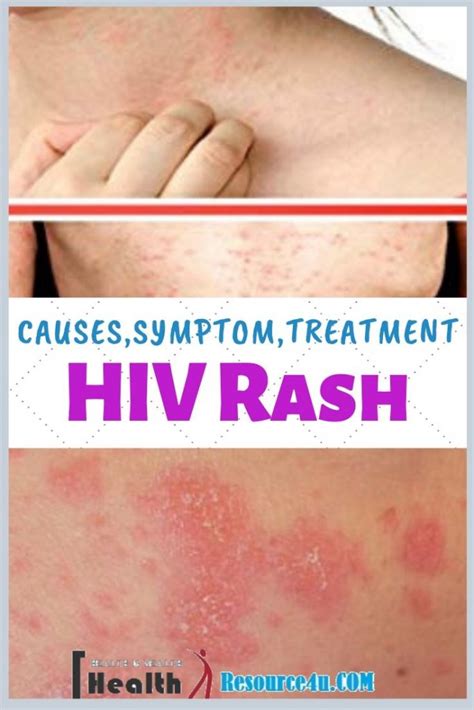 Hiv Rash Causes Picture Symptoms Types Home Treatment