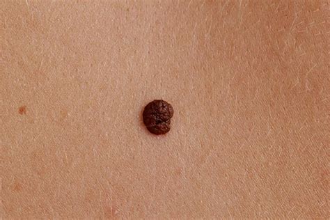 Mole Removal Manchester Skin Treatment Skin Medical