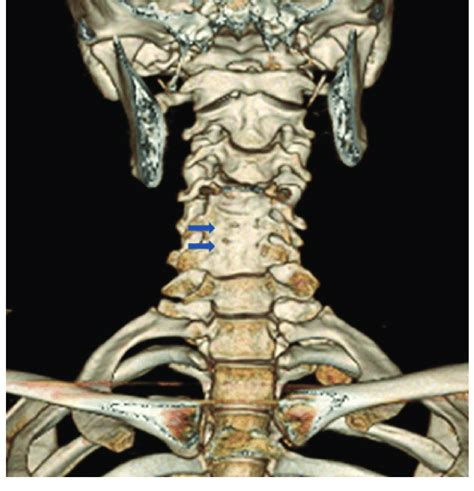 D Reconstruction CT Scan Of The Cervical Spine Of A Yearold Girl Download Scientific