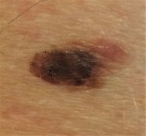 Dermoscopy Melanoma Skin Cancer Can Be Fatal Unless Caught Early But