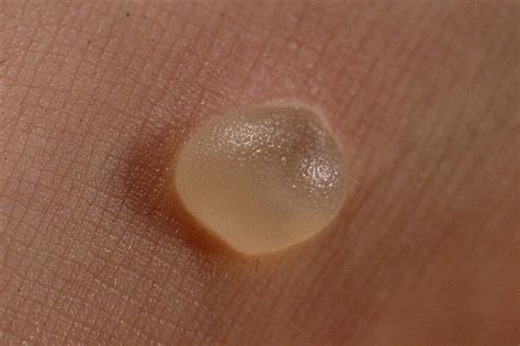 Skin Blisters Causes Treatment And Prevention