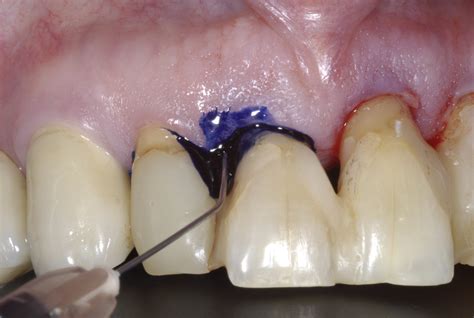 Is Photodynamic Therapy An Effective Treatment For Periodontal And Peri