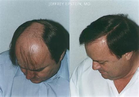 Hair Transplants For Men Photos Miami FL Patient39266