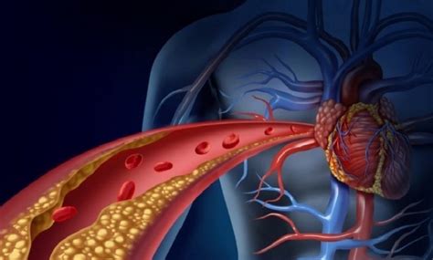 Malattie Cardiovascolari Il Ruolo Dei Pcsk In Caso Di Colesterolo