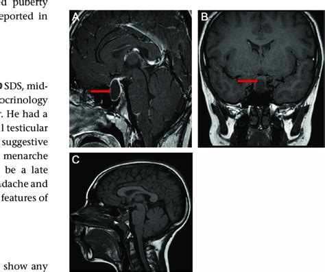 Mri Pituitary With Contrast Revealing A Cystic Lesion In The Pituitary